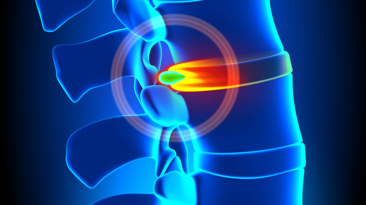 Hernie_de-disc_lombara_clinica_recuperare_brasov