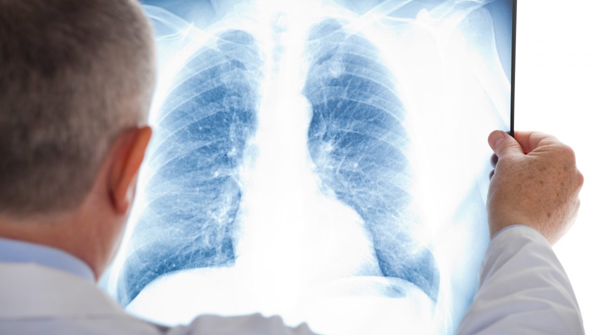 tuberculoza2